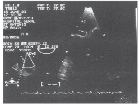 Fig 1 (seta)  ETE com imagem de vegetação no bordo auricular do folheto anterior da válvula mitral.