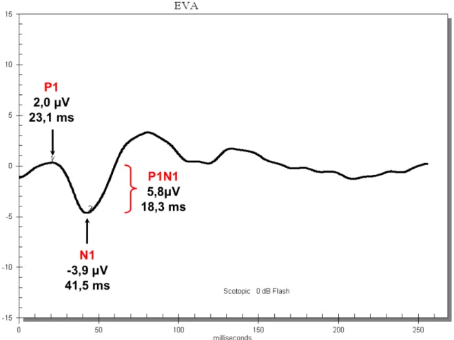 Figura 5. Valores das médias de amplitude das ondas P1, N1 e do componente P1N1 e das médias de tempo de culminação  das ondas P1 e N1 e da duração do componente P1N1 para 280 olhos de 140 indivíduos normais, incluindo todas as faixas  etárias e ambos os s