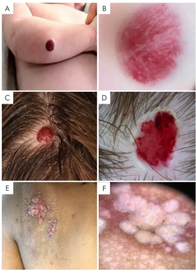 Figura 7 -  Patologia benigna vascular. (A) Hemangioma infantil: placa vermelho-vivo em bebé de 3 meses