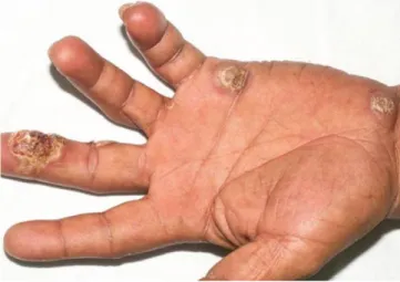 Figura 2 -  Placas eritematosas, de superfície crostosa em região pal- pal-mar. Úlcera necrótica em terceiro quirodáctilo da mão esquerda.