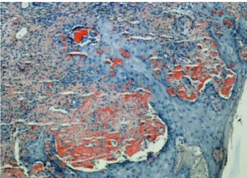 Figura 2 -  Exame histológico com imagem de depósitos congófilos da  substância amiloide na derme (vermelho do Congo, x100).