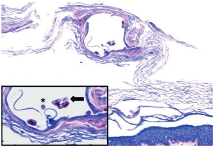 Figura 1 -  Aspecto  histopatológico  de  biópsia  cutânea  (coloração  hematoxilina-eosina  –  H&amp;E,  40x;  detalhe  com  ampliação  100x)   reve-lando ácaro (seta) e cíbalas (asterisco) no interior de galeria na camada  córnea.