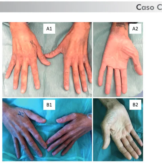 Figura 3 -  Dorso e palma das mãos antes do tratamento com ivermectina (A1 e A2) e um mês após tratamento com ivermectina (B1 e B2).