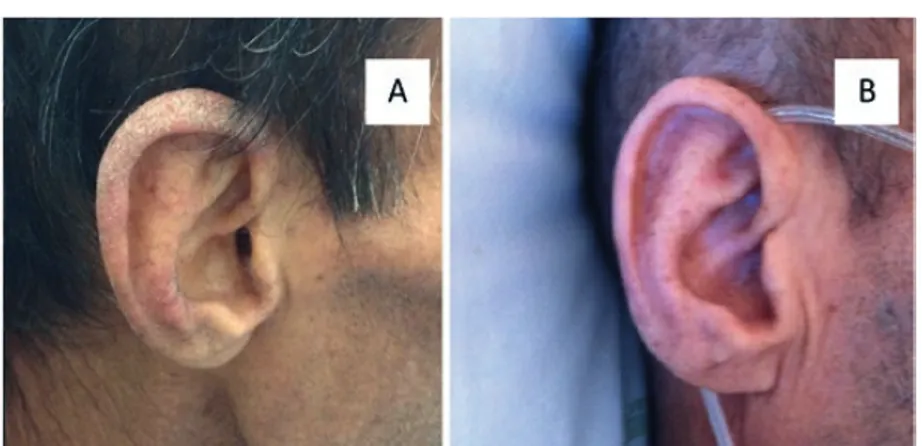 Figura 5 -  Pavilhão auricular antes do tratamento com ivermectina (A) e um mês após tratamento com ivermectina (B).