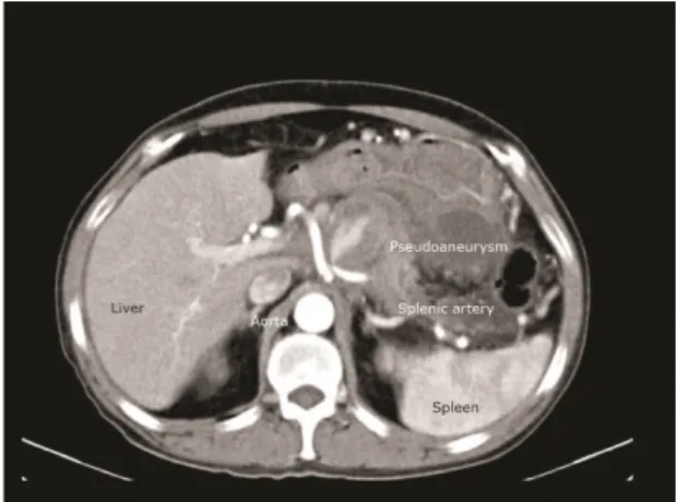 Figure 1. Computed tomography showing pseudoaneurysm  of the splenic artery.
