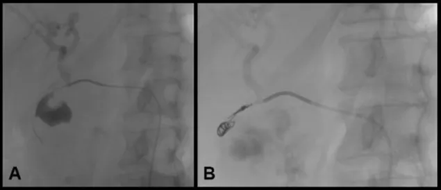 Figure 2. Arteriography showing pseudoaneurysm of the  splenic artery.