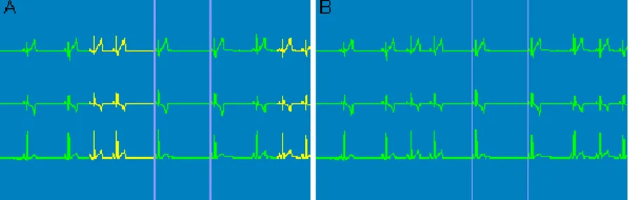 Figura  5 –  Representação  de dois  segmentos  correspondentes,  cada um, a  7,5  segundos  de um traçado Holter com arritmia sinusal respiratória   (NorthEast Monitoring, Inc.) 
