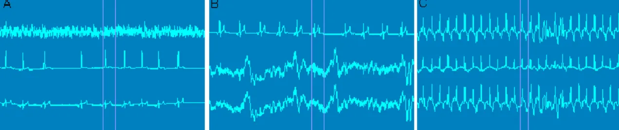 Figura 6 – Representação de três segmentos correspondentes, cada um, a 7,5 segundos de  um traçado Holter com artefactos   (NorthEast Monitoring, Inc.) 