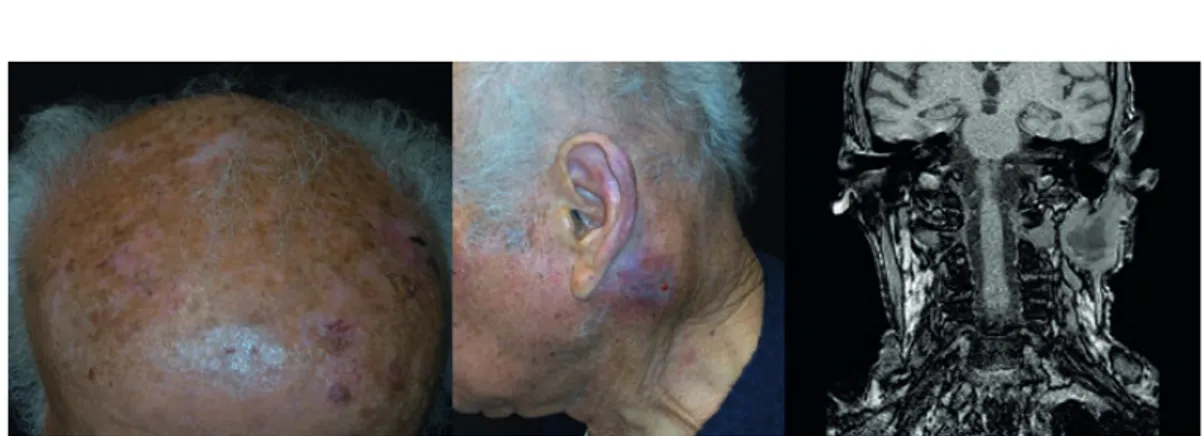 Figura 1 -  Doente do sexo masculino, 92 anos, com massa retroauricular esquerda com drenagem sero hemática espontânea com 2 meses de evolu- evolu-ção, que surge após 2 anos da excisão de carcinoma espinocelular do couro cabeludo, também do lado esquerdo