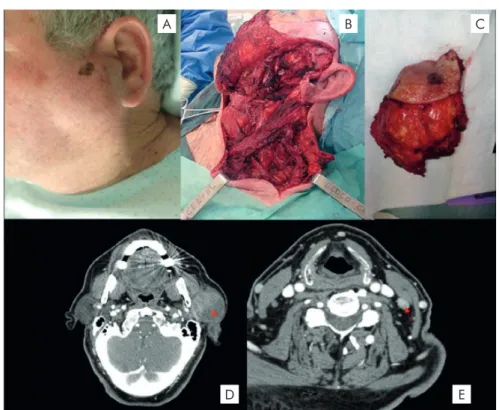 Figura 3 -  Caso de melanoma maligno com metástases parotídeas metástases parotídeas e cervicais de melanoma maligno
