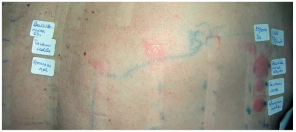 Figure 7 -  Positive photopatch test to benzydamine. Note that the erythema is only seen in the irradiated site.