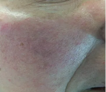 Figure 3 -  Papulo-pustular rosacea.