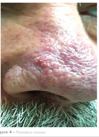 Figure 4 -  Phymatous rosacea.