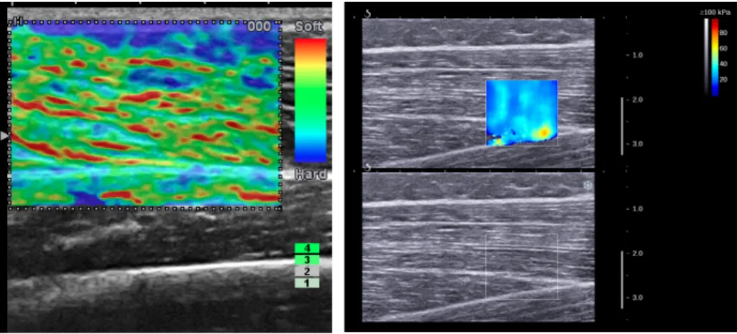 Figure  4:  Elastography  by  ultrasound  imaging.  (A)  Quasi-static  elastography;  (B)  shear  wave elastography