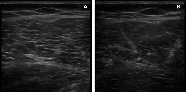 Figure 7: B mode ultrasound imaging of the vastus lateralis muscle. (A) Without artefact; 