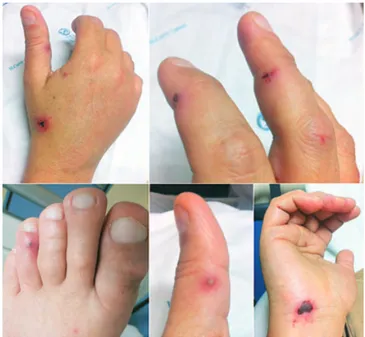 Fig 1 - On  physical  examination  (admission),  scarce  acral necrotic pustules on an erythematous base on the  hands, lateral borders of fingers and toes with swelling,  pain and functional limitation of the affected fingers and  toes