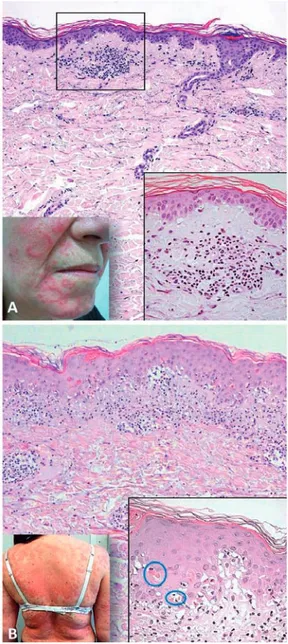 Fig 3 - Lúpus eritematoso subagudo. A. Doente do sexo  feminino,  62  anos,  variante  anular/  policíclica