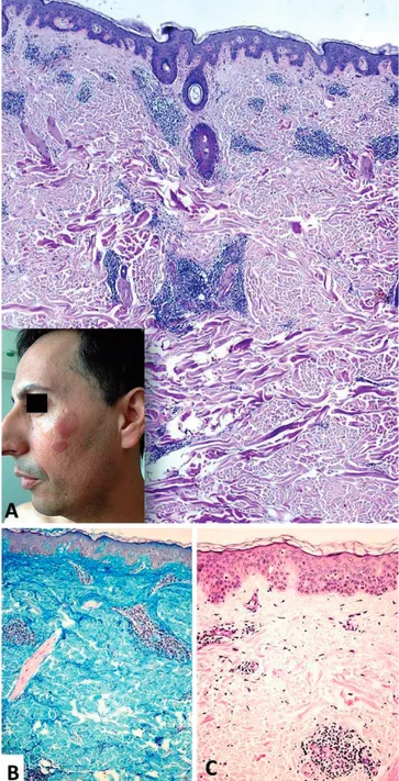 Fig 6 - Lúpus eritematoso túmido. A. Doente do sexo  masculino,  45  anos,  lesões  em  placa,   eritemato-vio-láceas, edematosas, sem escama e assintomáticas