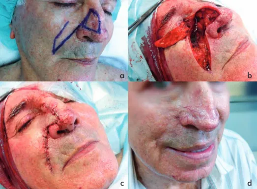 Fig 5 - a) Carcinoma basocelular envolvendo a parede lateral direita do nariz; b) Defeito cirúrgico e RNG levantado; c) Pós- Pós--operatório imediato; d) 1 ano pós- operatório.