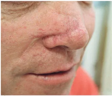 Fig 10 - Cinco anos após execução de RNGT para a pa- pa-rede lateral direita do nariz