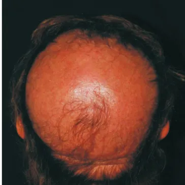 Fig 1 - Placa de alopecia única, com descamação e  eritema perifolicular na periferia da lesão.