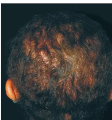 Fig 4 - Corte  histológico  longitudinal  de  couro  cabeludo  corado  com  hematoxilina-eosina,  mostrando  infiltrado   in-flamatório  irregular  em  derme  papilar,  que  acompanha  a  morfologia do folículo piloso e é composto por células  mo-nonuclear