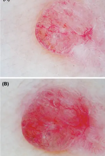 Fig 3 - Observação dermatoscópica de carcinoma baso- baso-celular nodular do braço. (A) a pressão exercida sobre a  superfície do tumor induz o colapso de algumas estruturas  vasculares; (B) a ausência de contacto facilita a observação  dos vasos arborifor
