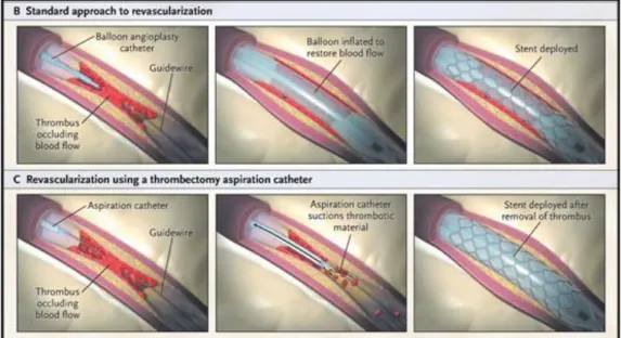 Figure 13 – Percutaneous Coronary Intervention (PCI) 
