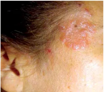 Fig 1 - Placa eritematosa, relativamente bem delimitada,  localizada na região malar no doente n.º2.