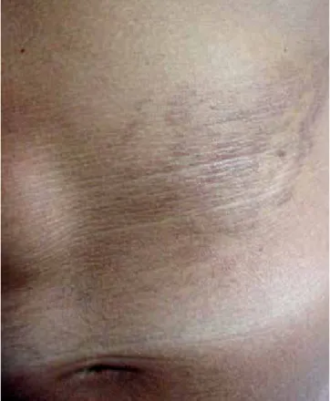 Fig 3 - Pápulas confluentes da cor da pele não afectada,  1-2mm de diâmetro, brilhantes e de superfície lisa.