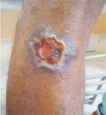 Fig. 1 - Ulcerated Kaposi’s Sarcoma lesion with a clean base  and well-defined violaceous borders on the right leg.