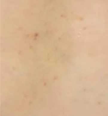 Fig. 2 - Pápulas da cor da pele normal, acinzentadas ou erite- erite-matosas, foliculares.