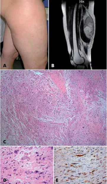 Fig. 4 - Caso 4: Leiomiossarcoma – (A) Fotografia clínica  da doente. (B) Ressonância magnética da coxa direita (C) e  (D) Exame histológico de biópsia da lesão, com coloração  hematoxilina-eosina
