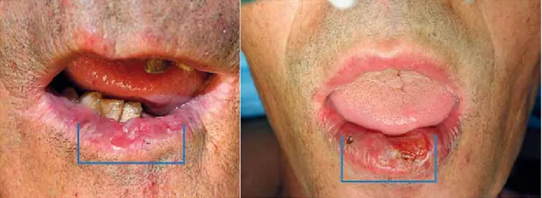 Fig. 1 - 1º Caso: carcinoma espinhocelular do lábio inferior; 2º Caso: carcinoma espinhocelular do lábio inferior.