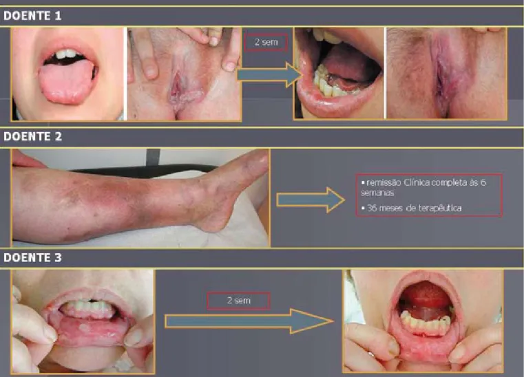 Fig. 3 - Doentes com doença de Behçet tratadas com infliximab.