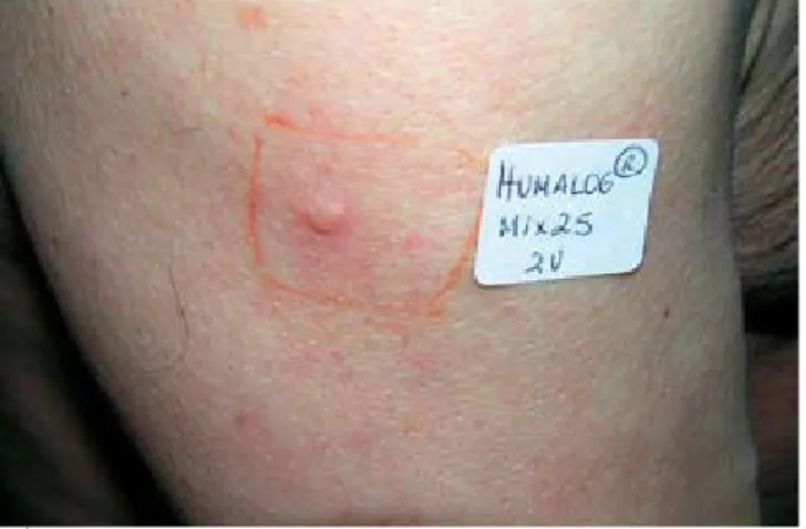Fig. 1 - Lesão urticariforme abdominal em local de prévia  administração de insulina Humalog ®  Mix 25