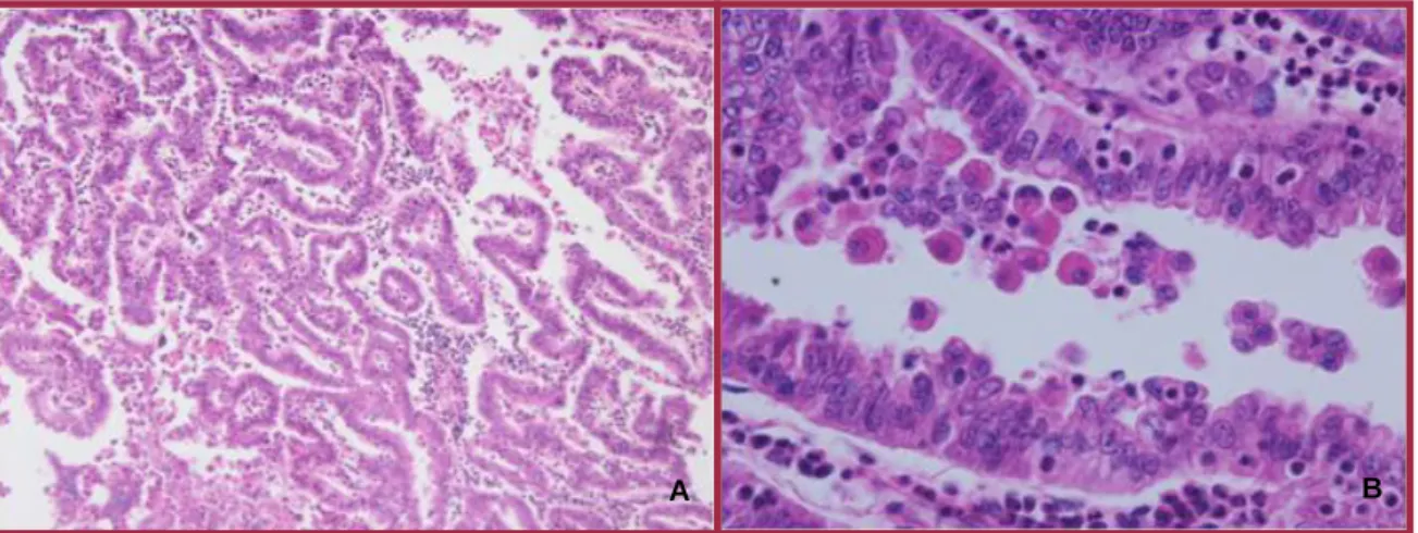 Figura  1:  Padrão  histológico  de  adenocarcinoma  papilífero.  A:  H&amp;E,  100x;  B:  H&amp;E,  400x