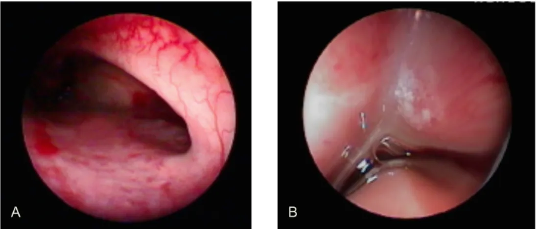 Figura 2. Imagens das cavidades nasais direita e esquerda obtidas por rinoscopia de um dos animais  em estudo (paciente 6)