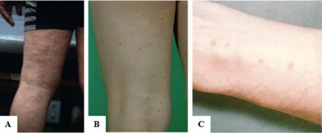 Figura 10 – Casos de Dermatite cercariana; A - (Soldánová et al., 2013);  