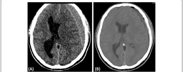 Figure 1 Computerized tomography scans (CT). (A) chronic subdural hematoma; (B) CT-scan 24 h after surgery.