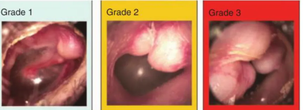 Fig 7.: Classificação de exostoses. Grau 0 – exostose não é visível; Grau 1 – menos  de 1/3 de obstrução; Grau 2 – 1/3 a 2/3 de obstrução; Grau 3 – mais de 2/3 de  obstrução [18]