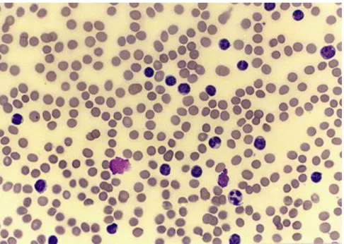 Figura 2 – Variedade linfocítica no sangue periférico na LLC.  Adaptado de (12)  É  possível  observar  a  variedade  de  pequenos  linfócitos  B,  assim  como  as  sombras  de  Gumprecht ou smudge cells, linfócitos malignos que sofreram rutura durante a p