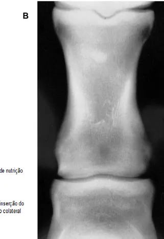 Figura  5  -  A.  Vista  DP  da  articulação  IFP  anatomia;  B.  Vista  DP  da  articulação  IFP  no  RX