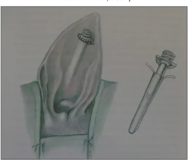 Figura 10 – Dreno mamário adaptado para resolução de um otohematoma (adaptado de  Hedlund et al., 2002) 