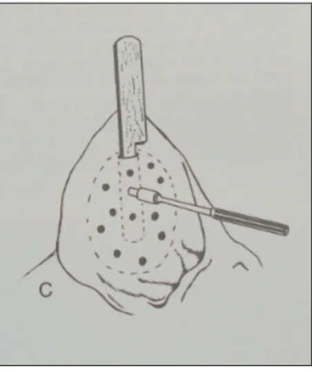 Figura 11 – Técnica de reparação de um otohematoma através de múltiplos orifícios  efectuados com um punch de biópsias dérmicas (adaptado de Krahwinkel, 2003) 