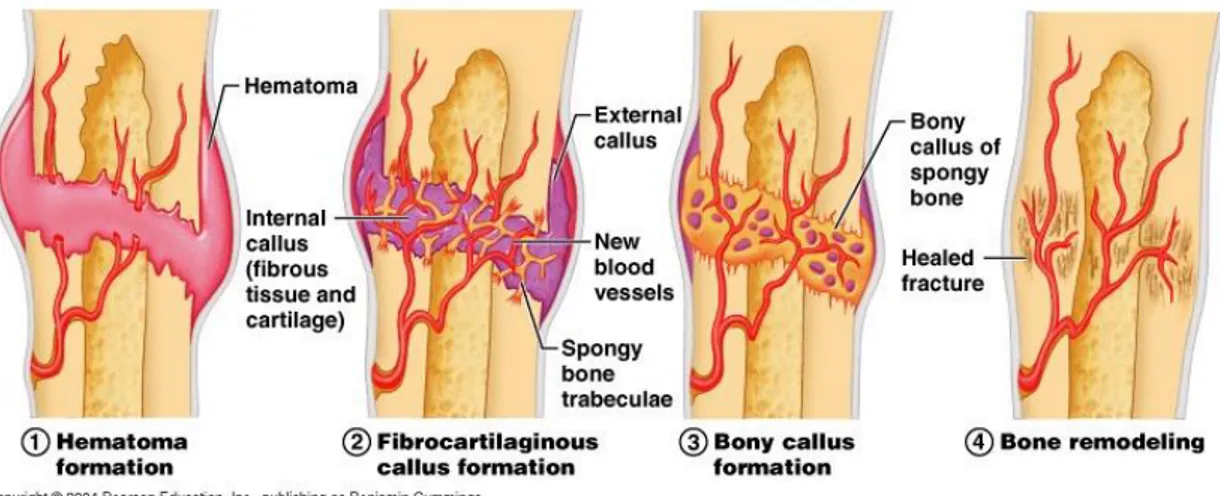 Figure 4- Bone healing steps. 