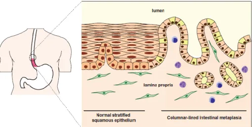 Figura I:Estrutura do epitélio escamoso estratificado do esófago e alteração em epitélio colunar com  metaplasia intestinal em esófago de Barrett (EB), no 1/3 inferior do esófago (adaptado de: Phillips W  A et al