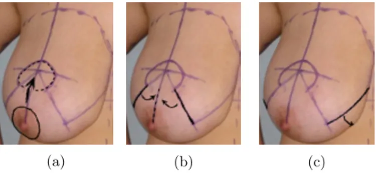 Figure 1.1: Breast reduction surgery.