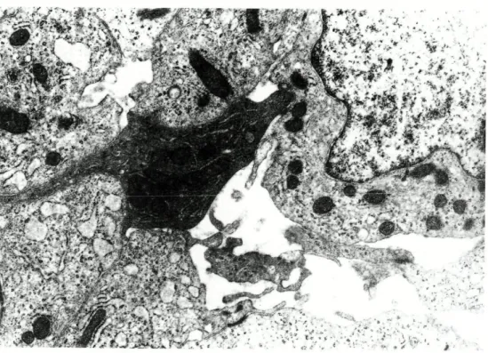 FIG. 11 BSS: Abortive glandular structure lined by epithelioid cells. Uranyl acetate  and lead citrate, x 7 1,400