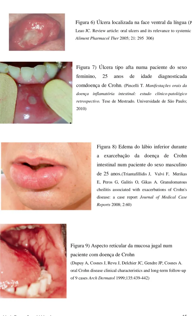 Figura  8)  Edema  do  lábio  inferior  durante  a  exarcebação  da  doença  de  Crohn  intestinal  num paciente do sexo  masculino  de  25  anos